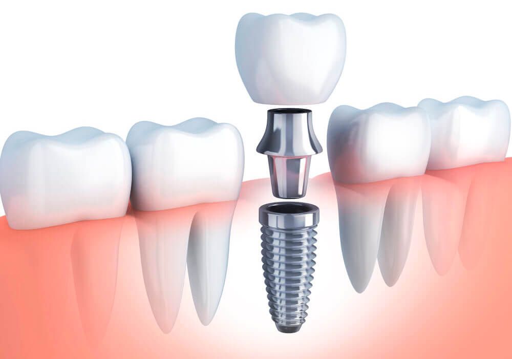 Імплантація зубів – простота та переваги процедури